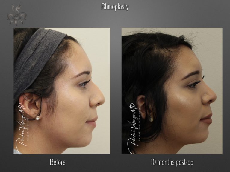 Rhinoplasty before and after