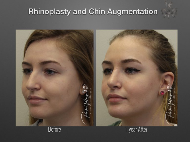 Rhinoplasty before and after