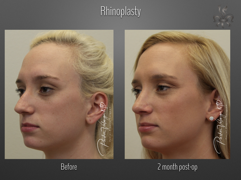 Rhinoplasty before and after