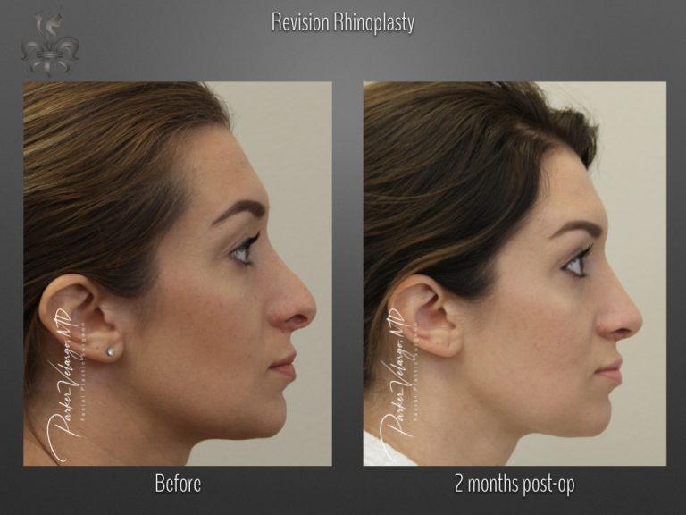 Rhinoplasty before and after