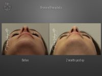 Rhinoplasty before and after