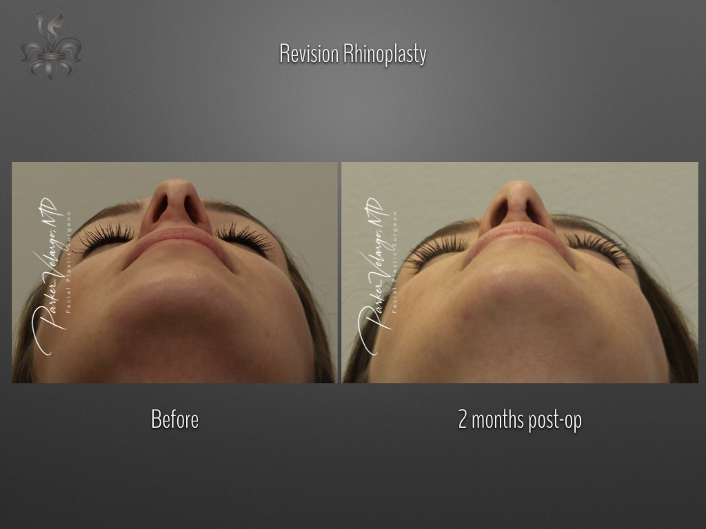 Rhinoplasty before and after