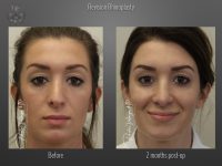 Rhinoplasty before and after