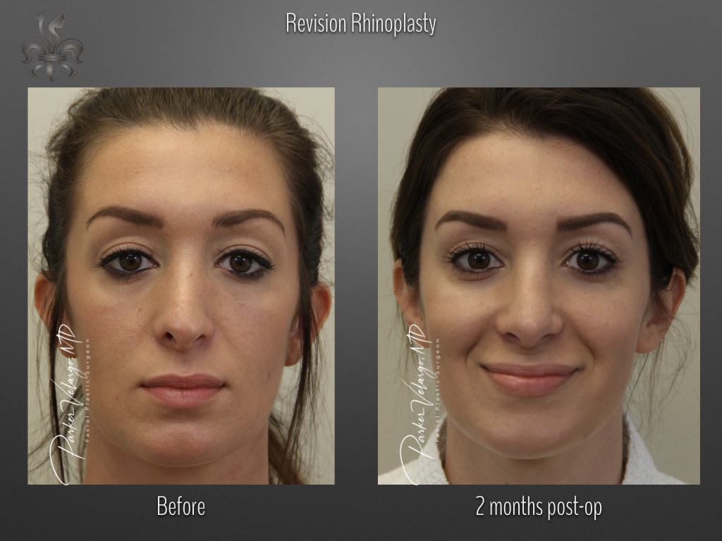 Rhinoplasty before and after