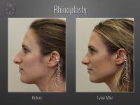 Rhinoplasty before and after