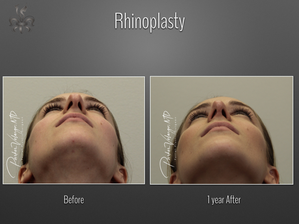 Rhinoplasty before and after