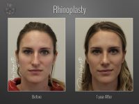 Rhinoplasty before and after