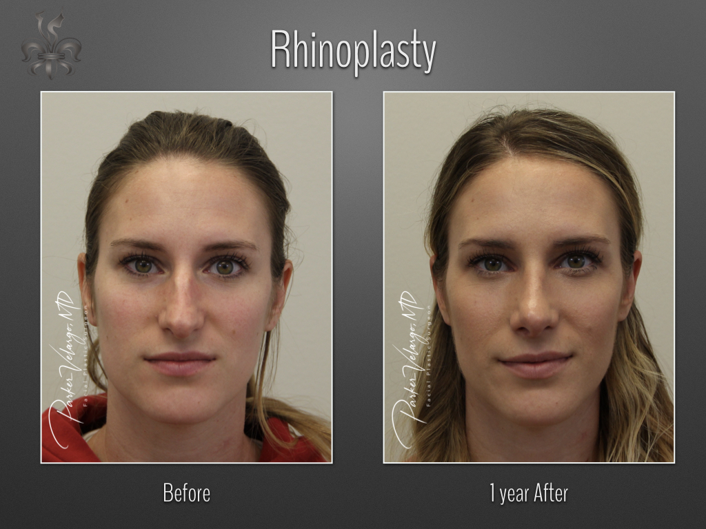 Rhinoplasty before and after