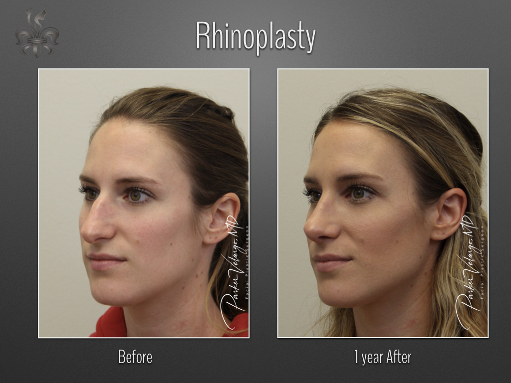 Rhinoplasty before and after