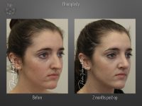 Rhinoplasty before and after