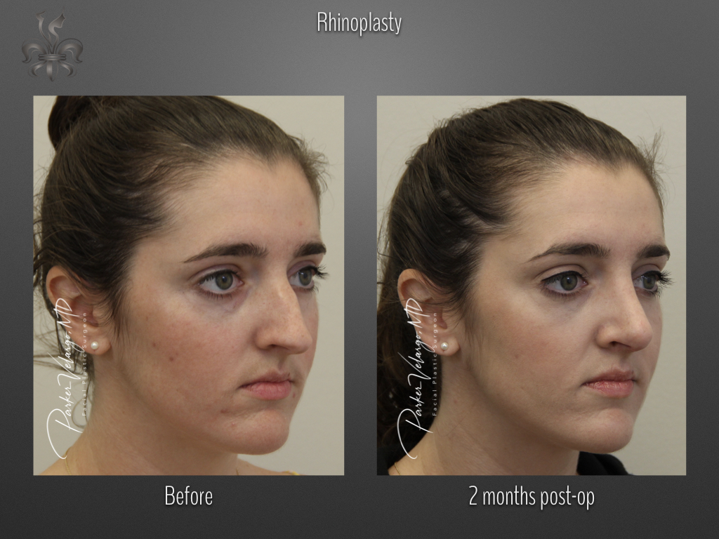 Rhinoplasty before and after