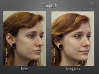 Rhinoplasty before and after