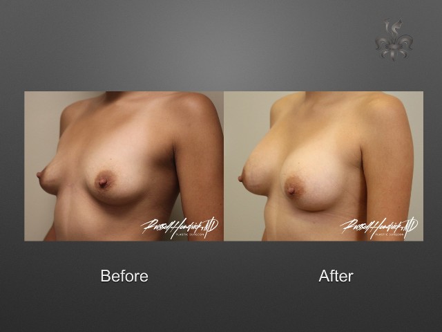 breast augmentation before and after