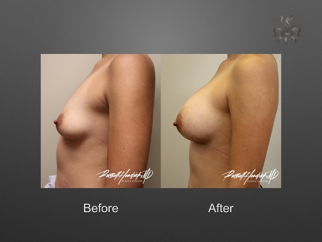 breast lift before and after