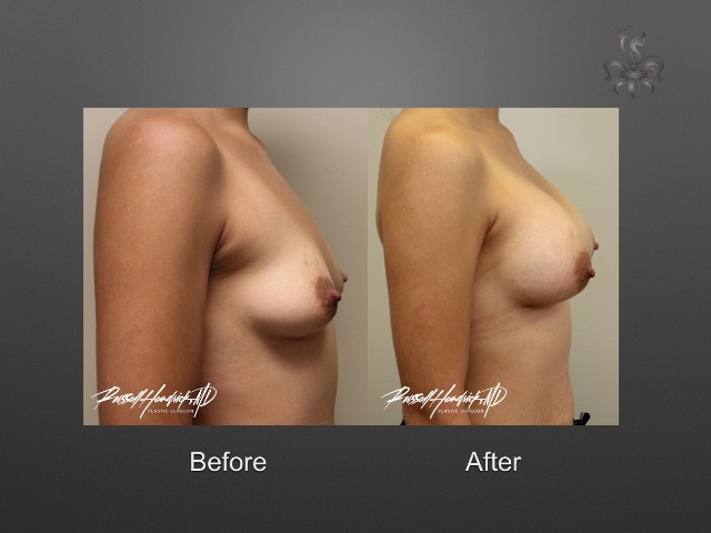 breast lift before and after