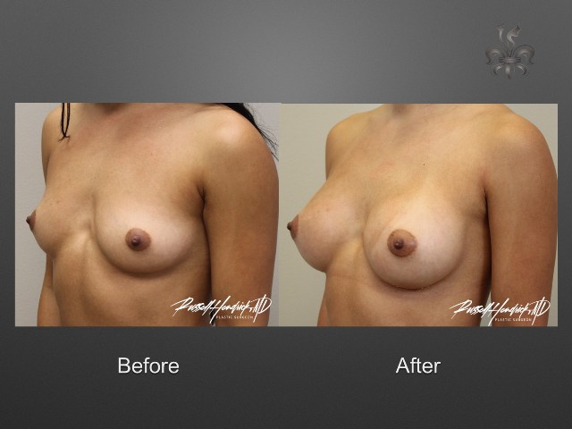 breast lift before and after