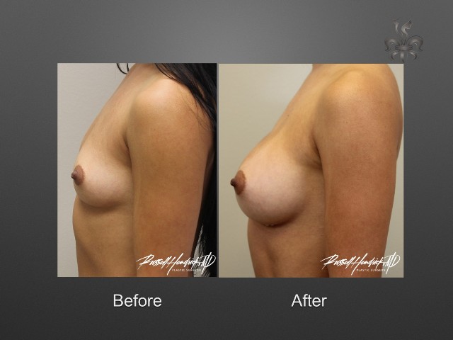 breast lift before and after