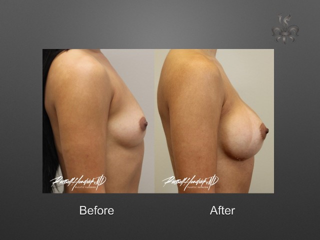 breast augmentation before and after