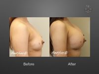 breast lift before and after