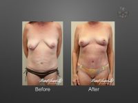 breast lift before and after