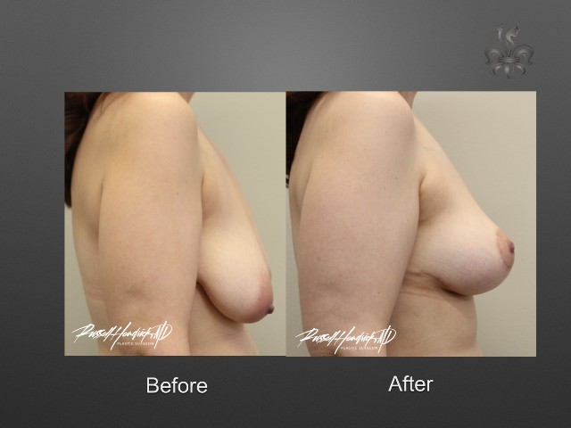 breast lift before and after