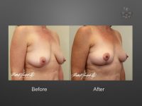 breast lift before and after
