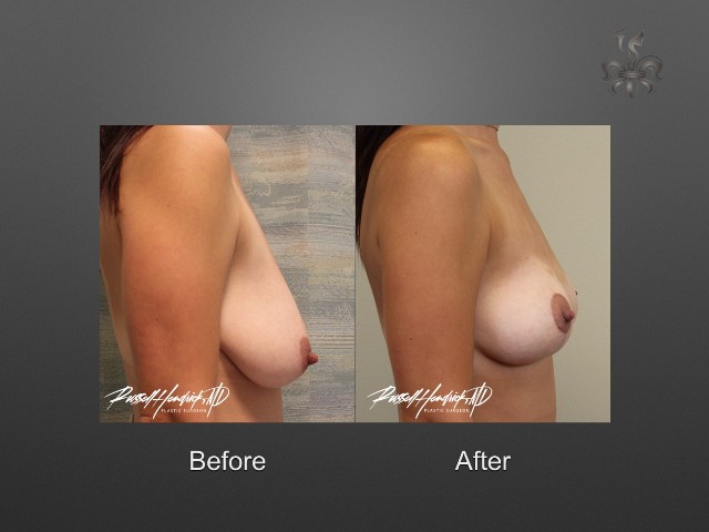 breast lift before and after