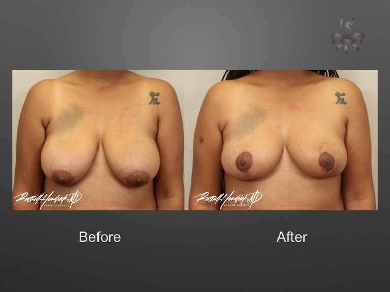 breast reduction before and after