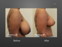 breast reduction before and after