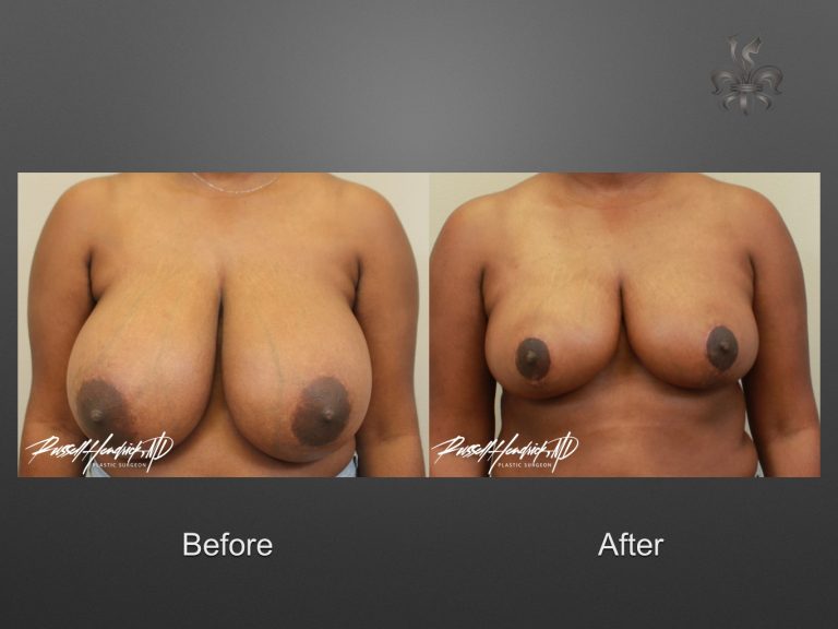 breast reduction before and after