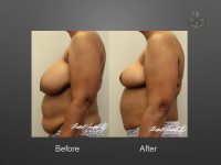 breast reduction before and after