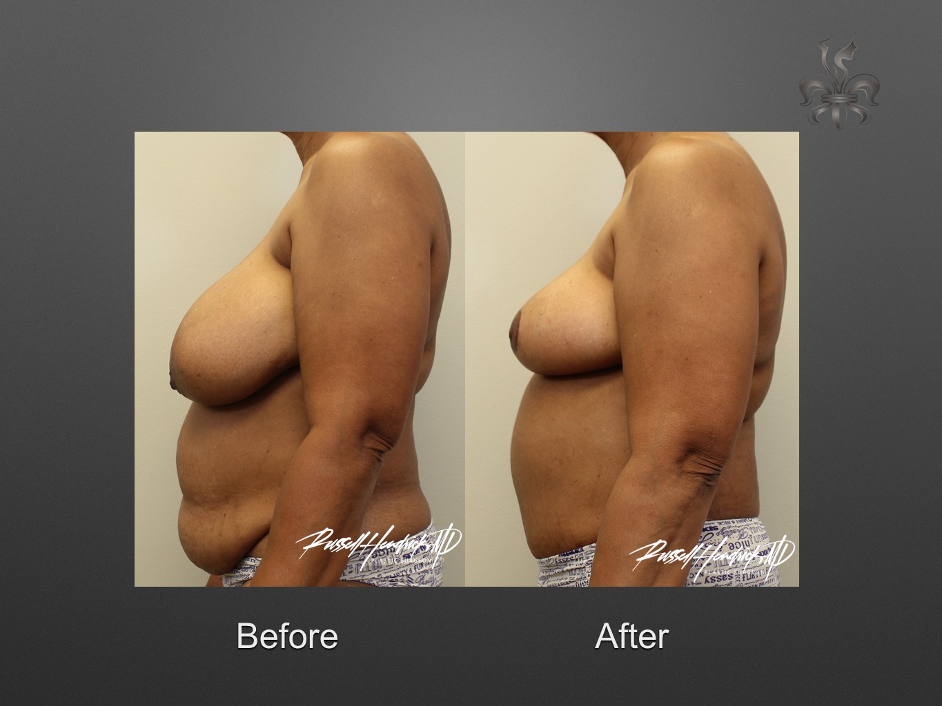 breast reduction before and after
