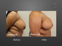 breast reduction before and after