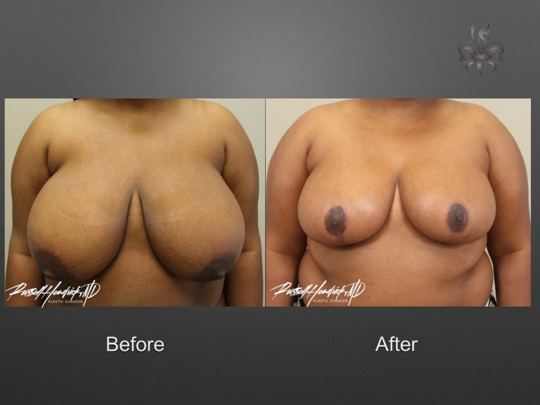 breast reduction before and after