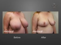breast reduction before and after