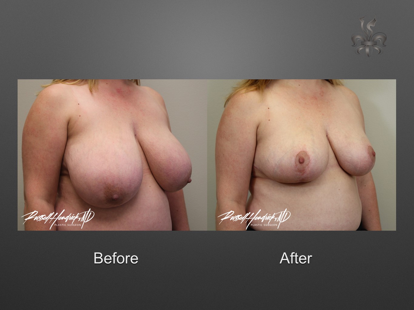breast reduction before and after