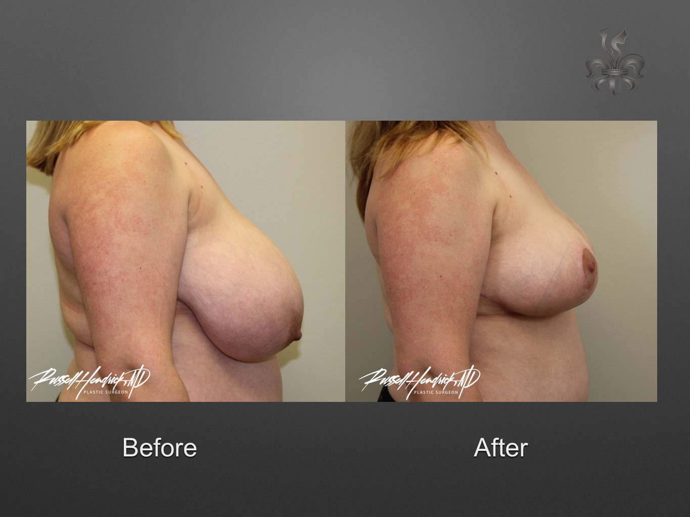 breast reduction before and after