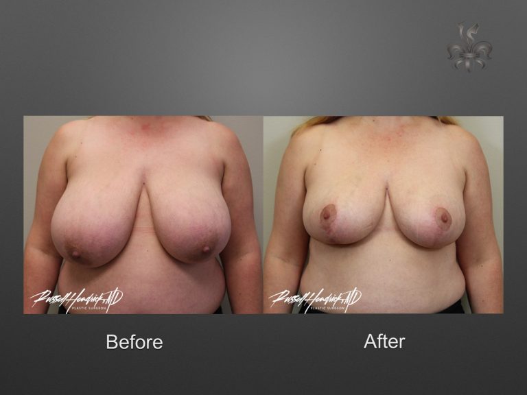 breast reduction before and after