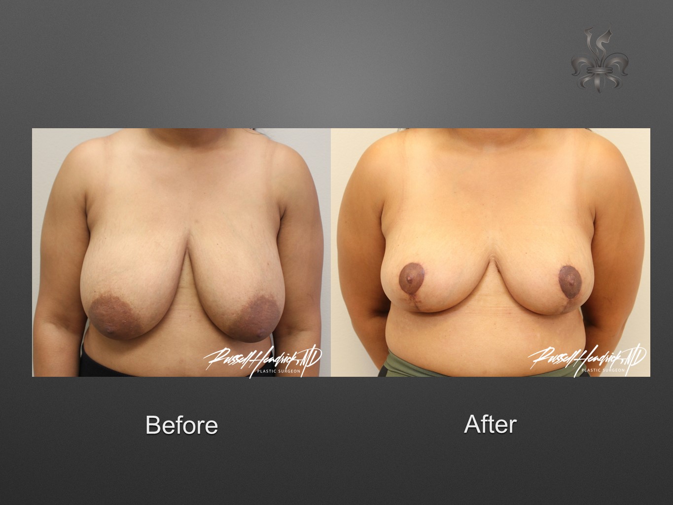 breast reduction before and after