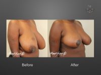 breast reduction before and after