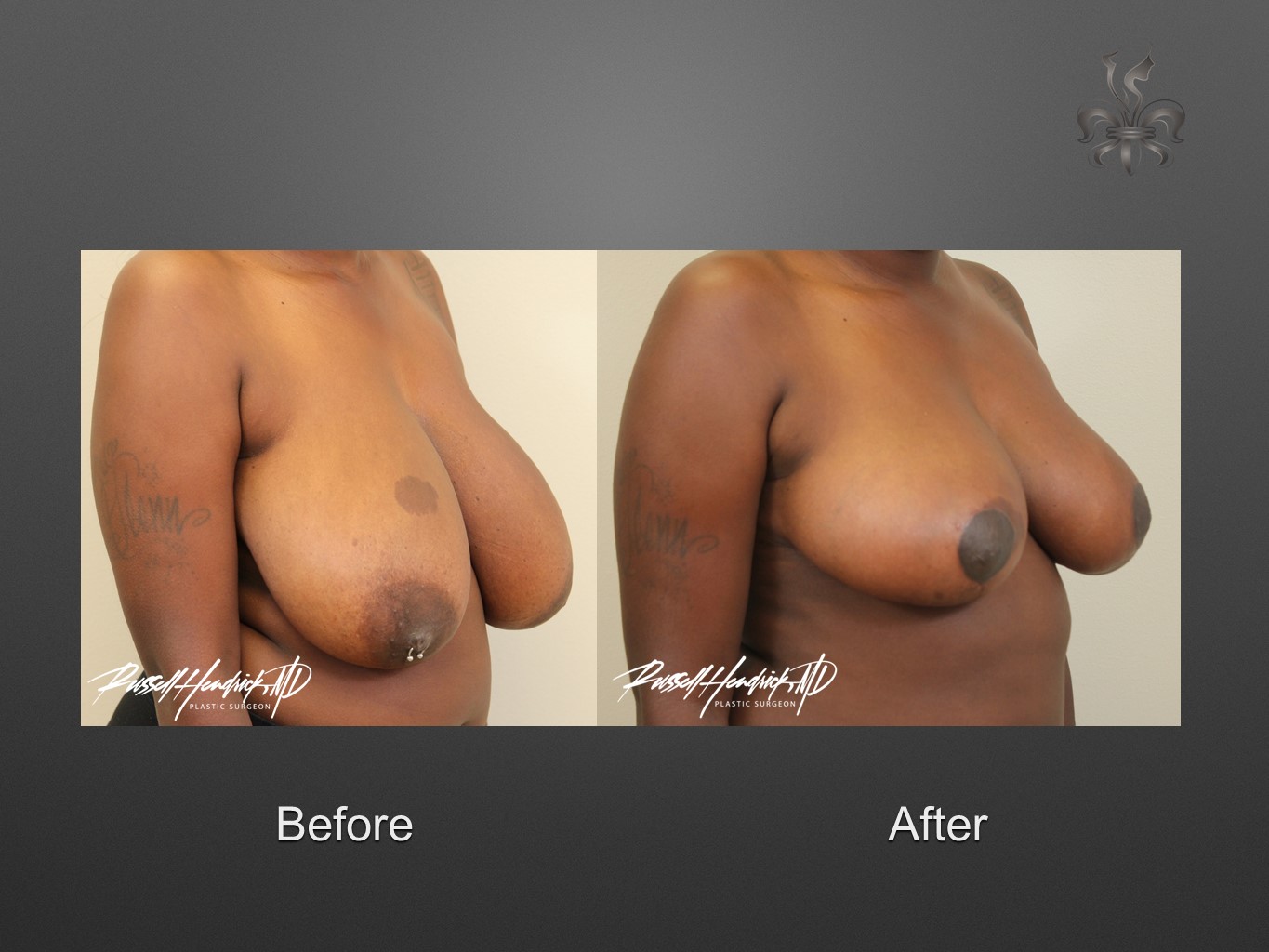 breast reduction before and after