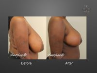 breast reduction before and after