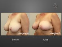 breast reduction before and after