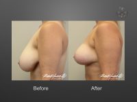 breast reduction before and after