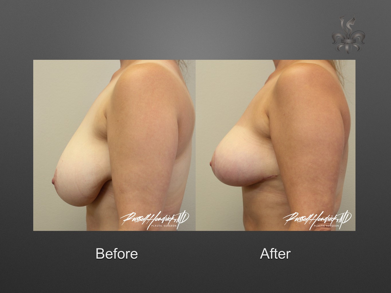 breast reduction before and after