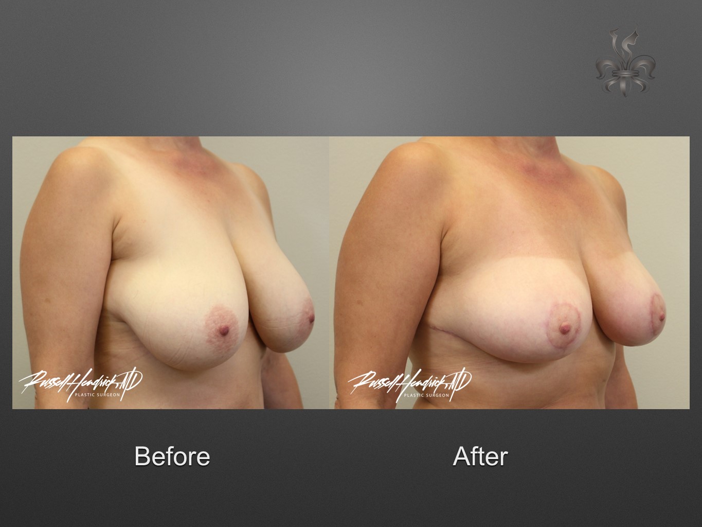 breast reduction before and after