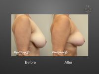 breast reduction before and after