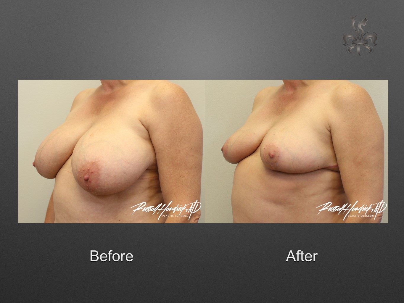 breast reduction before and after