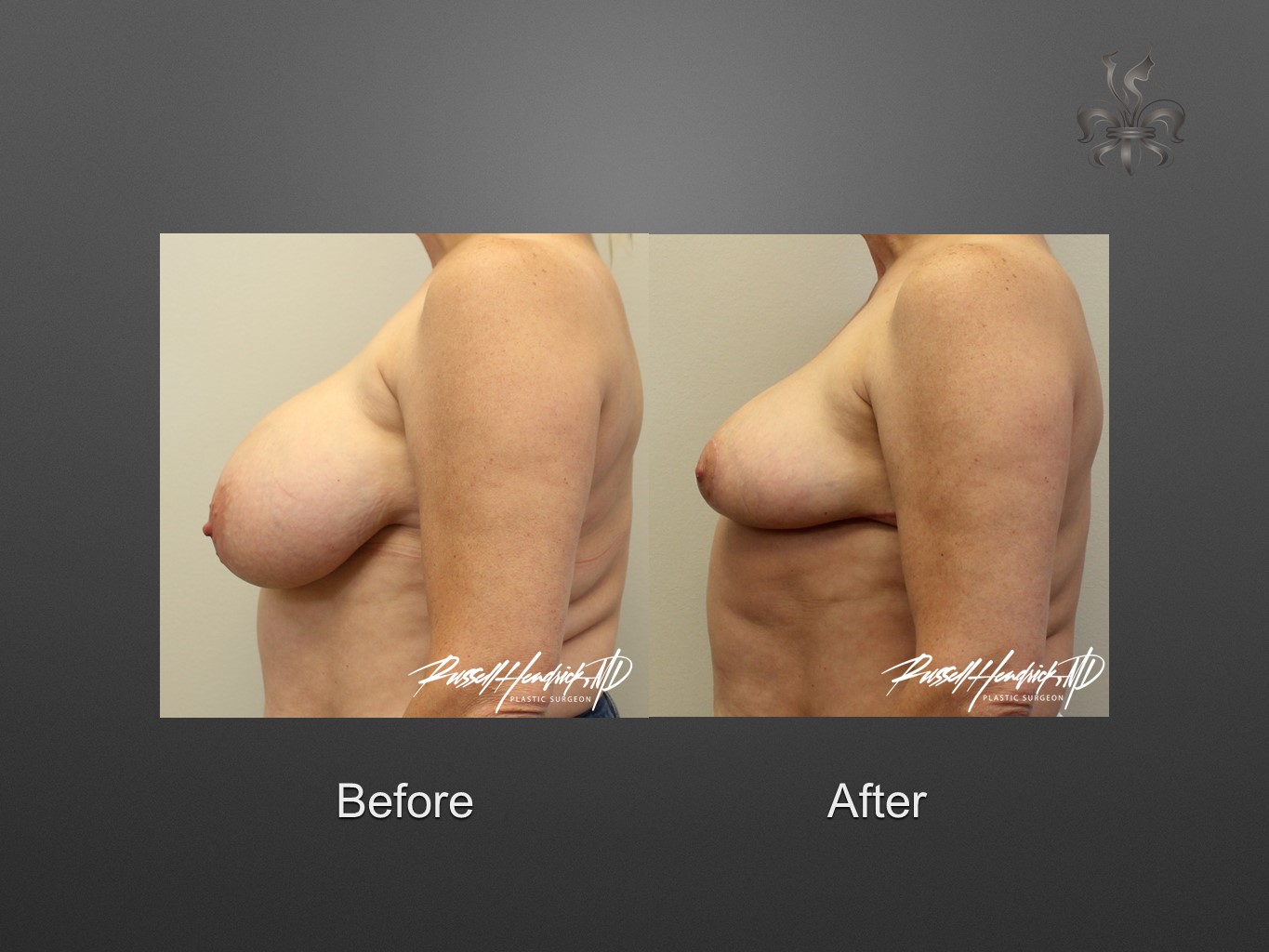 breast reduction before and after