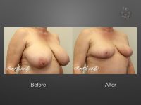 breast reduction before and after